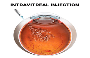 Eye Injections/ Retina Injections/ Intravitreal Injections