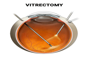 Retina Surgery